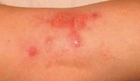 Wyprysk (eczema)