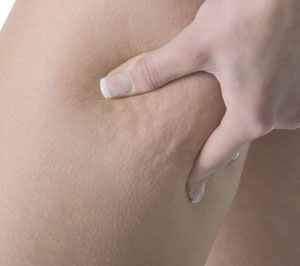 Nowe sposoby leczenia cellulitu