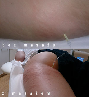 Kreatywna karboksyterapia